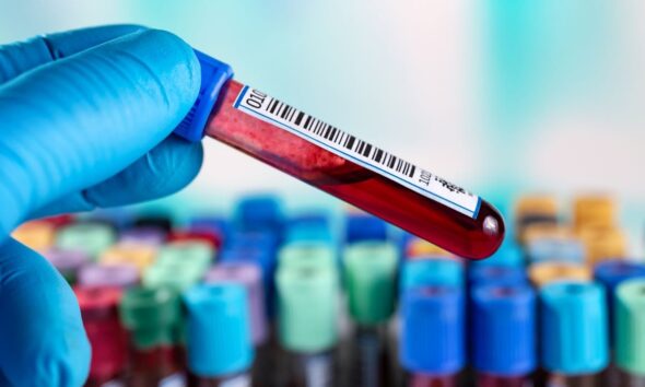 Blood Test Beats Doctors for Early Diagnosis of Alzheimer's Disease